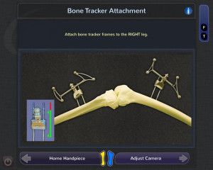 Blue Belt Technologies Knee Robot: bone tracker placement